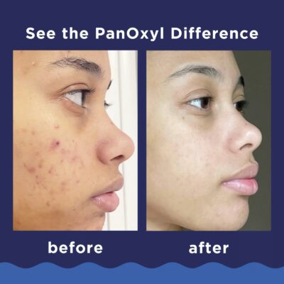 PanOxyl
Nettoyant moussant contre l’acné pour le visage et le corps, Efficacité maximale, 85 g