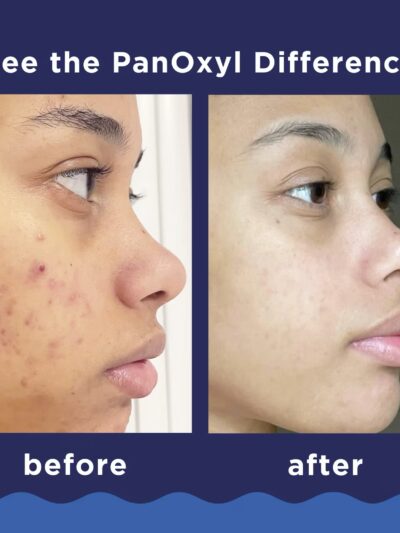 PanOxyl
Nettoyant moussant contre l’acné pour le visage et le corps, Efficacité maximale, 85 g