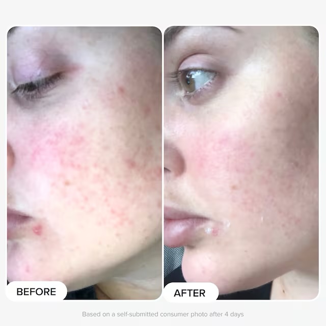 PAULA'S CHOICE
Boost - Booster 10% Acide Azélaïque – Image 2